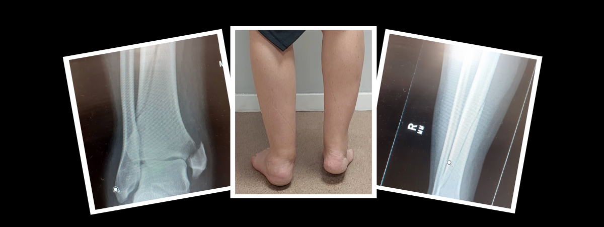 Three images with white borders, two of x-rays showing broken bones and one showing swollen legs and feet