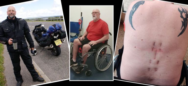Gordon, an experienced biker, pictured next to his motorbike. Gordon then pictured in a wheelchair following the crash. A picture of Gordon's scarring following surgery to his back.