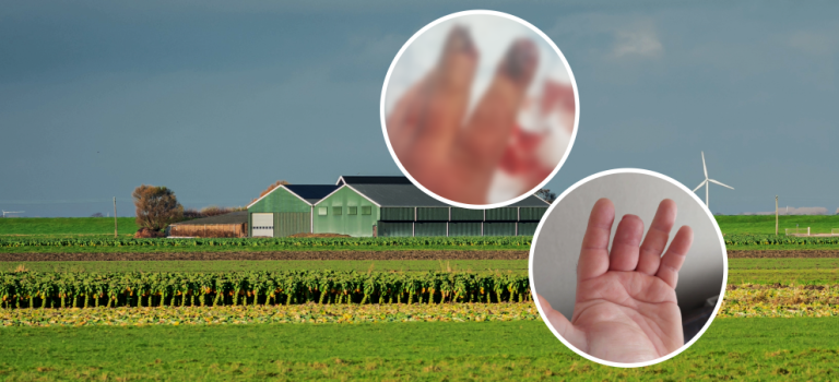 This picture shows a brussels sprout farm and has two pictures of our client's injuries within two white circles. The client lost half of their middle finger in an accident involving the blades in the brussels sprout harvester.