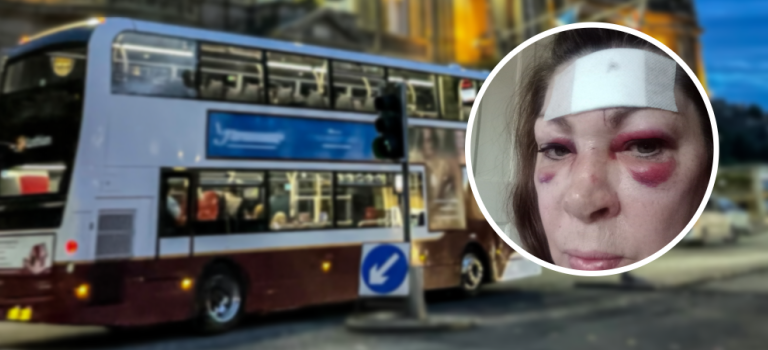 Gran awarded five-figure compensation after bus accident leaves scar