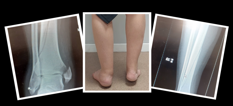 Three images with white borders, two of x-rays showing broken bones and one showing swollen legs and feet